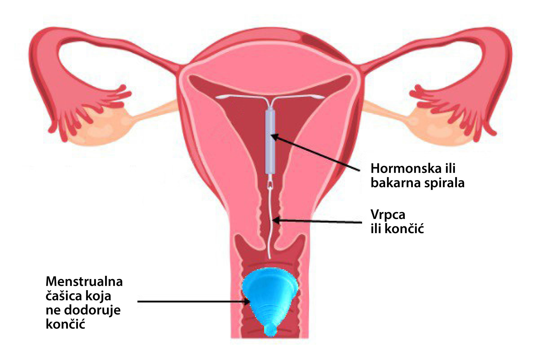 Menstrualna čašica i spirala