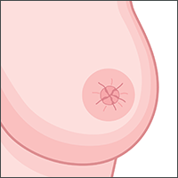 Koji su znaci i simptomi raka dojke?